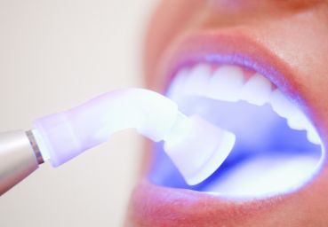 Clareamento a laser: dentes brancos sem desconforto